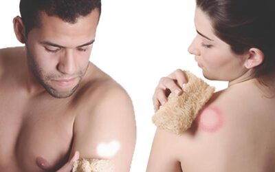 UFF Responde: Hanseníase